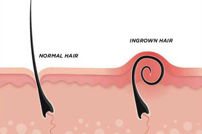 ingrown-hair