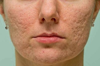 Frontal view of girl's cheeks and chin with acne scars